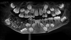 “충치인 줄 알고 치과 데려간 7살 아들 턱에서 치아 526개가 발견됐습니다”