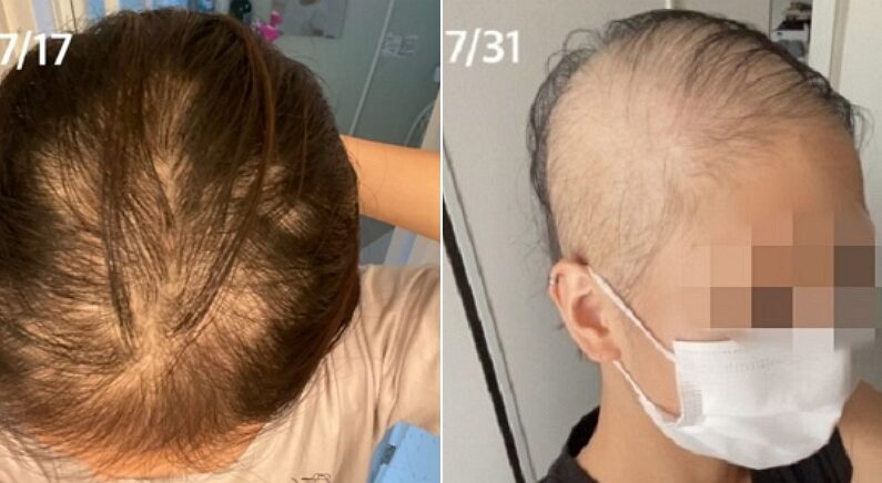일본 20대 여성 “모더나 백신 맞고 한 달 만에 머리카락 다 빠져”