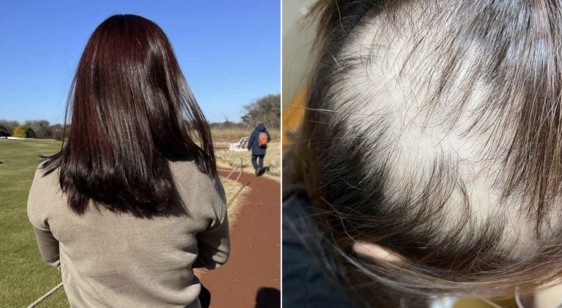 “손만 대도 머리카락이 우수수” 모더나 접종 뒤 ‘탈모 증상’ 호소한 20대 여성